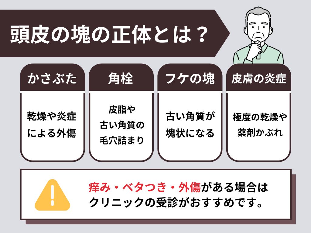 頭皮から塊が取れる？その正体とは