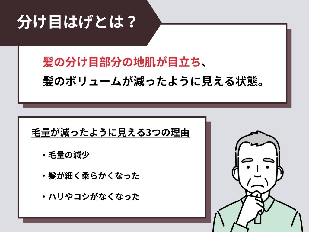 分け目はげとは？